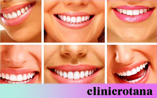 إعادة تأهيل الفم الكامل في تركيا